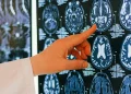 Head injuries may increase the risk of brain cancer