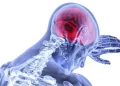 آیا هوش مصنوعی می تواند در تعیین محل آسیب مغز پس از سکته نقش داشته باشد